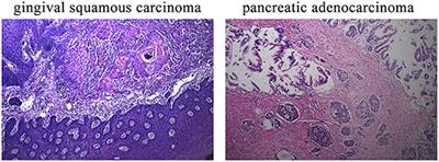 Case Report: Novel RPGRIP1L Gene Mutations Identified by Whole Exome Sequencing in a Patient With Multiple Primary Tumors